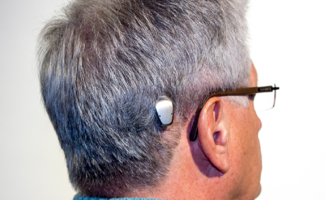 Bone Conduction Implant